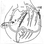Stents from my Heart Attack